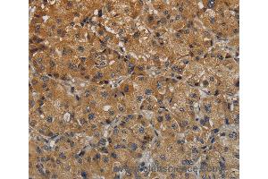 Immunohistochemistry of Human thyroid cancer using TAB1 Polyclonal Antibody at dilution of 1:40