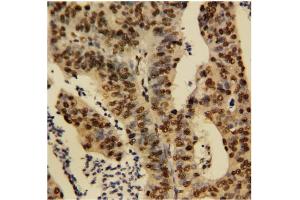 Immunohistochemical staining of Human rectal cancer