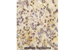 Formalin-fixed and paraffin-embedded human prostata carcinoma tissue reacted with MEN1 Antibody  (ABIN391614 and ABIN2841535) , which was peroxidase-conjugated to the secondary antibody, followed by DAB staining. (Menin Antikörper  (AA 584-615))