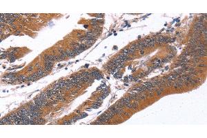 Immunohistochemistry of paraffin-embedded Human colon cancer tissue using GREB1 Polyclonal Antibody at dilution 1:40 (GREB1 Antikörper)