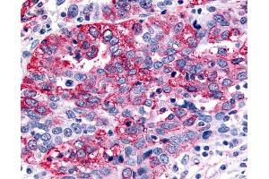 Anti-GABABR1 / GABBR1 antibody IHC of human Ovary, Carcinoma. (GABBR1 Antikörper  (N-Term))