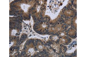 Immunohistochemistry of Human liver cancer using GK Polyclonal Antibody at dilution of 1:60