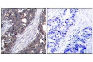 Immunohistochemical analysis of paraffin-embedded human breast carcinoma tissue using p70 S6 Kinase (Ab-411) antibody (E021261). (RPS6KB1 Antikörper)