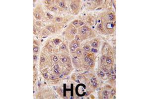Formalin-fixed and paraffin-embedded human hepatocellular carcinoma reacted with PIM3 polyclonal antibody  , which was peroxidase-conjugated to the secondary antibody, followed by DAB staining. (PIM3 Antikörper  (C-Term))