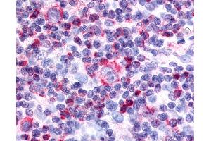 Anti-Nor-1 / NR4A3 antibody IHC of human Lymph Node, Hodgkins Lymphoma. (NR4A3 Antikörper  (Internal Region))