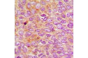 Immunohistochemical analysis of Nephrocystin 5 staining in human breast cancer formalin fixed paraffin embedded tissue section. (IQCB1 Antikörper  (Center))