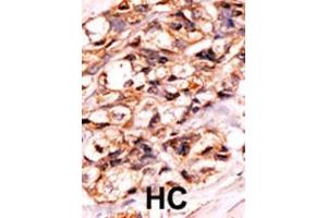 Formalin-fixed and paraffin-embedded human cancer tissue reacted with the primary antibody, which was peroxidase-conjugated to the secondary antibody, followed by AEC staining. (BAD Antikörper  (pSer118))