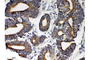Anti-Hsp60 Picoband antibody, (ABIN3043854), IHC(P)IHC(P): Human Intestinal Cancer Tissue