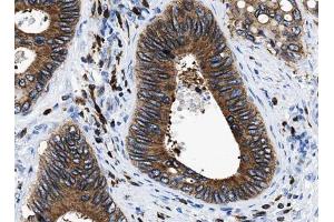 ABIN6266881 at 1/100 staining human Colorectal tissue sections by IHC-P. (HDAC5 Antikörper  (C-Term))