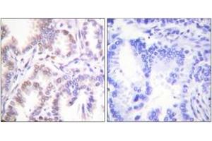 Immunohistochemistry analysis of paraffin-embedded human lung carcinoma tissue, using CDK7 Antibody. (CDK7 Antikörper  (AA 291-340))