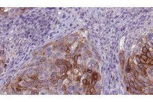 ABIN6275668 at 1/100 staining Human urothelial cancer tissue by IHC-P. (ATP6V1B1 Antikörper  (Internal Region))