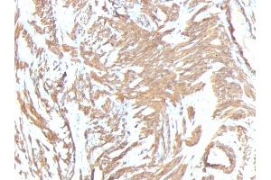 Formalin-fixed, paraffin-embedded human Leiomyosarcoma stained with Smooth Muscle Actin Monoclonal Antibody (1A4 + ACTA2/791). (Smooth Muscle Actin Antikörper  (N-Term))