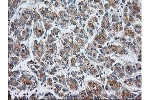 Immunohistochemical staining of paraffin-embedded Carcinoma of liver tissue using anti-CYP1A2 mouse monoclonal antibody. (CYP1A2 Antikörper)