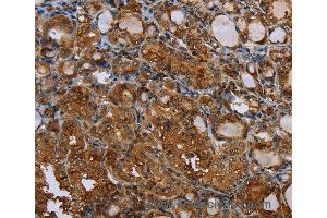 Immunohistochemistry of Human thyroid cancer using CSF2RA Polyclonal Antibody at dilution of 1:35