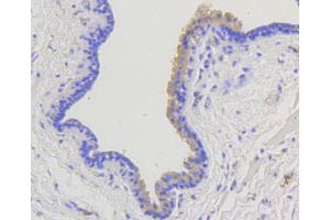 Immunohistochemistry of paraffin-embedded human mammary cancer using ARRB1 antibody (ABIN4903044) at dilution of 1:100 (40x lens). (beta Arrestin 1 Antikörper)