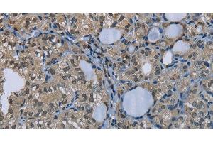Immunohistochemistry of paraffin-embedded Human thyroid cancer using GYS1 Polyclonal Antibody at dilution of 1:50