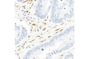 Immunohistochemistry of paraffin-embedded human colon carcinoma using QKI Rabbit mAb (ABIN7269699) at dilution of 1:1000 (40x lens). (QKI Antikörper)