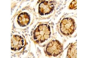 IHC analysis of FFPE human colon carcinoma stained with PDGFRL antibody (PDGFRL Antikörper  (AA 328-357))