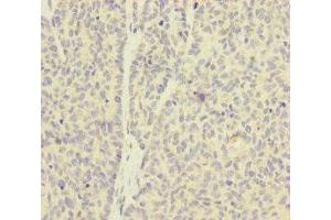 Immunohistochemistry of paraffin-embedded human ovarian cancer using ABIN7154941 at dilution of 1:100 (SKIV2L Antikörper  (AA 1-140))