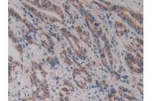 Detection of VNN1 in Human Stomach cancer Tissue using Polyclonal Antibody to Vanin 1 (VNN1) (VNN1 Antikörper  (AA 36-223))