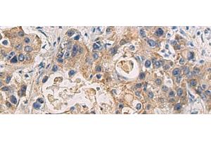 Immunohistochemistry of paraffin-embedded Human liver cancer tissue using DMRTA2 Polyclonal Antibody at dilution of 1:50(x200) (DMRTA2 Antikörper)