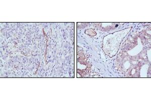 Immunohistochemical analysis of paraffin-embedded human stomach cancer (left) and ovary cancer (right) tissues using eNOS mouse mAb with DAB staining. (ENOS Antikörper)