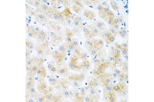 Immunohistochemistry of paraffin-embedded human liver cancer using DHODH antibody. (DHODH Antikörper  (AA 116-395))