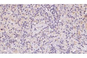 ABIN6273086 at 1/100 staining Human lymph cancer tissue by IHC-P. (VPS16 Antikörper  (Internal Region))
