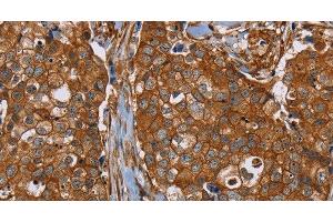 Immunohistochemistry of paraffin-embedded Human breast cancer tissue using PLEC Polyclonal Antibody at dilution 1:40 (PLEC Antikörper)