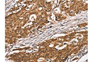 The image on the left is immunohistochemistry of paraffin-embedded Human gastric cancer tissue using ABIN7190465(DGAT1 Antibody) at dilution 1/40, on the right is treated with synthetic peptide. (DGAT1 Antikörper)