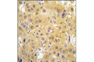 Formalin-fixed and paraffin-embedded human hepatocarcinoma tissue reacted with ECGF1 antibody (Center), which was peroxidase-conjugated to the secondary antibody, followed by DAB staining. (Thymidine Phosphorylase Antikörper  (Middle Region))