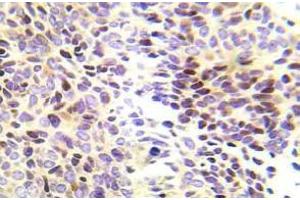 Immunohistochemistry (IHC) analyzes of CHK1 pAb in paraffin-embedded human lung adenocarcinoma tissue. (CHEK1 Antikörper)