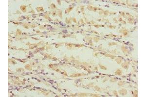 Immunohistochemistry of paraffin-embedded human gastric cancer using ABIN7146516 at dilution of 1:100 (Calpain S1 Antikörper  (AA 69-268))