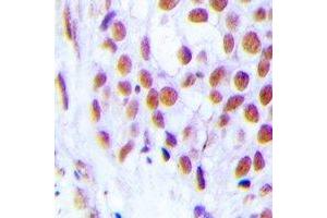 Immunohistochemical analysis of FOG2 staining in human breast cancer formalin fixed paraffin embedded tissue section. (ZFPM2 Antikörper)