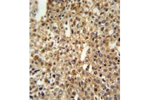 Formalin fixed and paraffin embedded human cervix carcinoma reacted with DENND1A Antibody (C-term) followed by peroxidase conjugation of the secondary antibody and DAB staining. (DENND1A Antikörper  (C-Term))