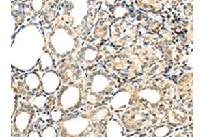 The image on the left is immunohistochemistry of paraffin-embedded Human thyroid cancer tissue using ABIN7192947(TSPYL6 Antibody) at dilution 1/20, on the right is treated with synthetic peptide. (TSPY-Like 6 Antikörper)
