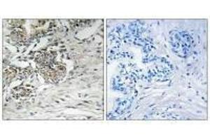Immunohistochemistry analysis of paraffin-embedded human prostate carcinoma tissue using Claudin 7 (Ab-210) antibody. (Claudin 7 Antikörper  (Tyr210))