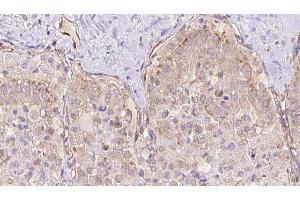 ABIN6273328 at 1/100 staining Human thyroid cancer tissue by IHC-P. (TBC1D23 Antikörper  (Internal Region))
