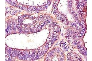 Immunohistochemistry of paraffin-embedded human endometrial cancer using ABIN7144954 at dilution of 1:100 (PFKM Antikörper  (AA 166-334))