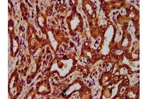 IHC image of ABIN7151907 diluted at 1:300 and staining in paraffin-embedded human liver cancer performed on a Leica BondTM system. (EGFL7 Antikörper  (AA 73-198))