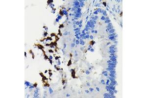 Immunohistochemistry of paraffin-embedded human colon carcinoma using FADD Rabbit mAb (ABIN7267135) at dilution of 1:100 (40x lens). (FADD Antikörper)
