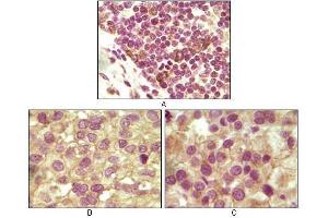 Immunohistochemical analysis of paraffin-embedded human lymphoid (A), ovary tumor (B) and testicle tumor (C) tissues using INHA antibody with DAB staining. (Inhibin alpha Antikörper)
