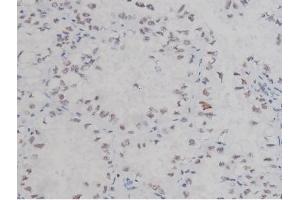 ABIN6267323 at 1/200 staining Human lung cancer tissue sections by IHC-P. (NPM1 Antikörper  (pThr199))