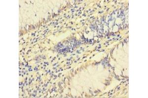 Immunohistochemistry of paraffin-embedded human colon cancer using ABIN7142784 at dilution of 1:100 (RPL26L1 Antikörper  (AA 1-145))