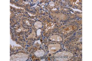 Immunohistochemistry of Human thyroid cancer using FADS1 Polyclonal Antibody at dilution of 1:60 (FADS1 Antikörper)