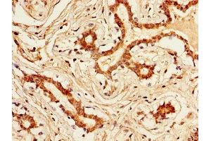 IHC image of ABIN7157190 diluted at 1:300 and staining in paraffin-embedded human breast cancer performed on a Leica BondTM system. (Kallikrein 1 Antikörper  (AA 25-262))