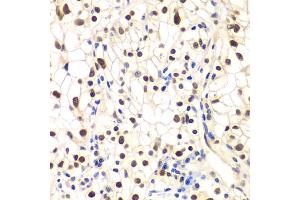 Immunohistochemistry of paraffin-embedded human kidney cancer using NFKBIB antibody (ABIN5973399) at dilution of 1/200 (40x lens). (NFKBIB Antikörper)