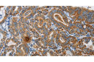 Immunohistochemistry of paraffin-embedded Human thyroid cancer using UPF1 Polyclonal Antibody at dilution of 1:35 (RENT1/UPF1 Antikörper)