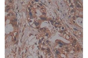 DAB staining on IHC-P; Samples: Human Pancreatic cancer Tissue (PRCP Antikörper  (AA 108-376))