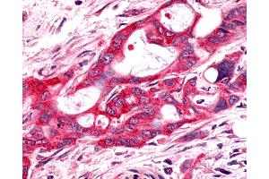 Anti-FZD9 / Frizzled 9 antibody IHC of human Pancreas, Carcinoma. (FZD9 Antikörper  (N-Term))